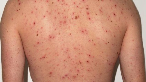 CDC advierte por repunte histórico de sarampión y recomienda precauciones en campamentos de verano