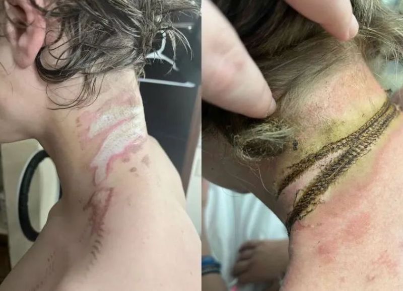 Adolescente de Oklahoma casi muere electrocutado después de que su collar entrara en contacto con un enchufe